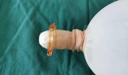 包皮手术 视频,专业视频带你了解手术细节